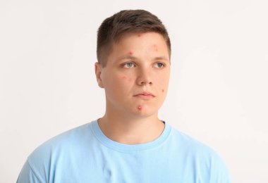 Sivilceli genç bir çocuk.