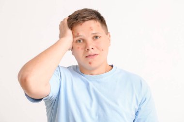 Sivilceli genç bir çocuk.