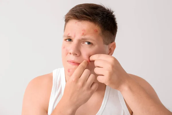 Teenage Boy Acne Problem Squishing Pimples Light Background — Stock Photo, Image