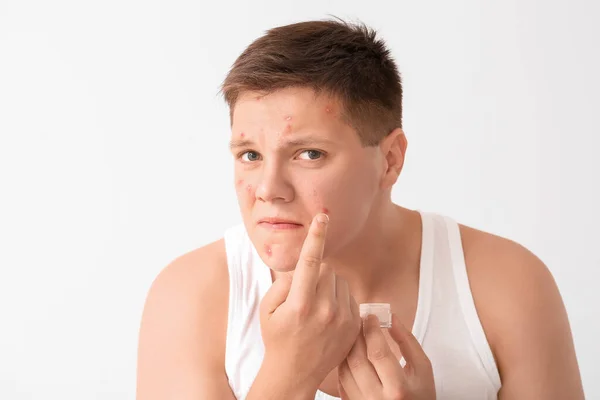 Teenage Boy Remedy Acne Light Background — Stock Photo, Image