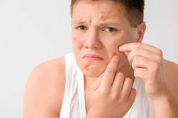 Teenage Boy Acne Problem Squishing Pimples Light Background — Stock Photo, Image