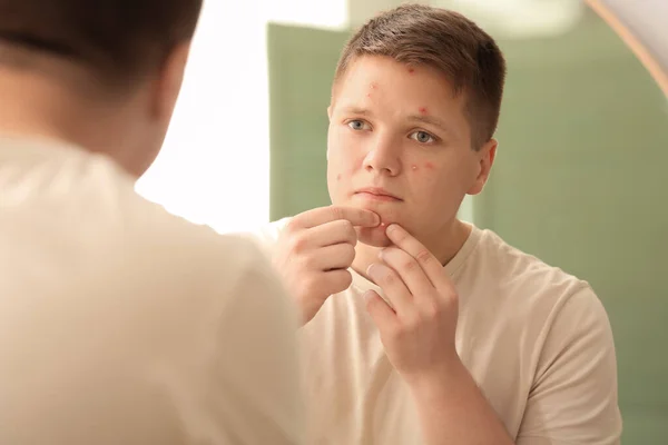 Teenage Boy Acne Squishing Pimples Mirror — Stock Photo, Image