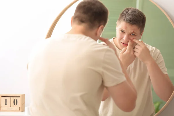 Teenage Boy Acne Squishing Pimples Mirror — Stock Photo, Image