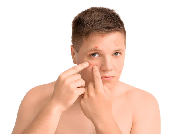 Teenage Boy Acne Squishing Pimples White Background — Stock Photo, Image
