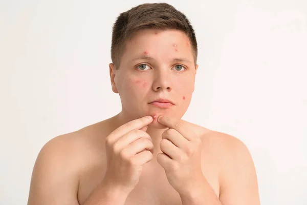 Teenage Boy Acne Squishing Pimples Light Background — Stock Photo, Image