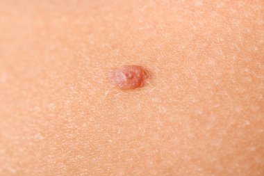 Benli insan derisi, yakın plan.