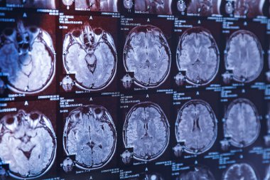 İnsan kafasının MRI taraması, yakın plan.