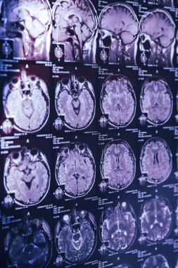 İnsan kafasının MRI taraması, yakın plan.