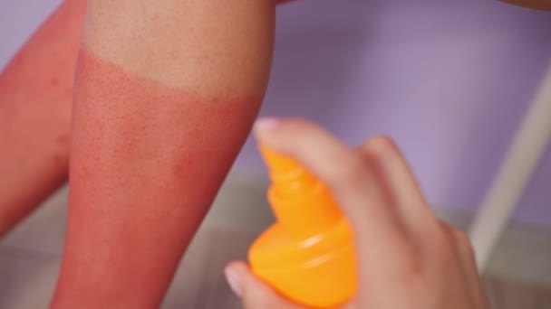 Applying Sunscreen Cream Red Sunburned Skin Closeup — Stock Video