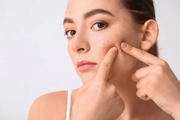 Mujer Joven Con Problemas Acné Aplastamiento Espinillas Sobre Fondo Blanco — Foto de Stock