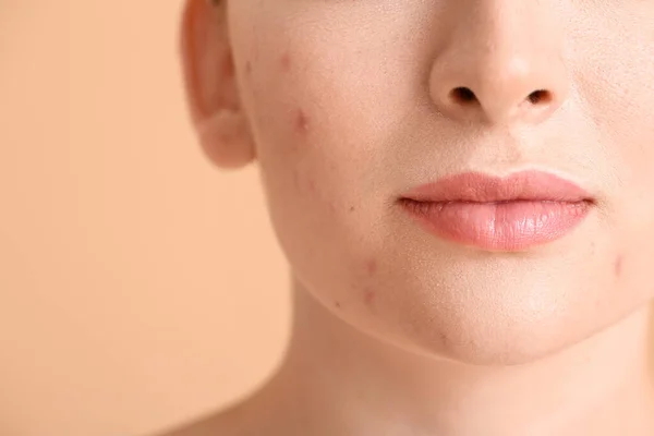 Young Woman Acne Problem Color Background Closeup — Stock Photo, Image