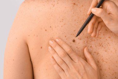 Dermatolog gri arka plandaki hastayı muayene ediyor.
