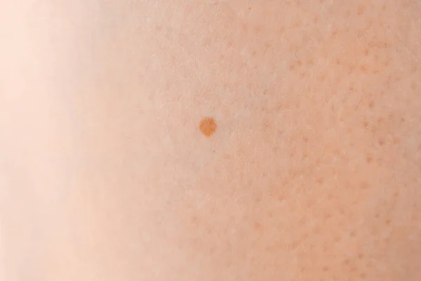 Menschliche Haut Mit Maulwurf Nahaufnahme — Stockfoto