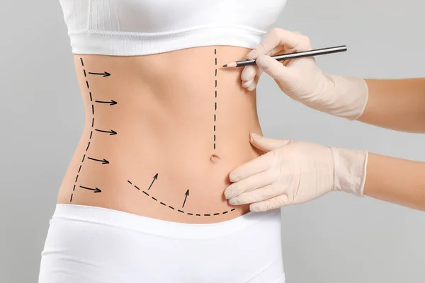 灰色の背景に女性の体にマークを適用する形成外科医 — ストック写真