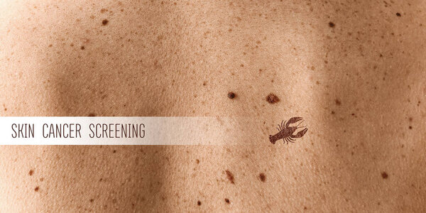 Human skin with moles, closeup. Concept of skin cancer