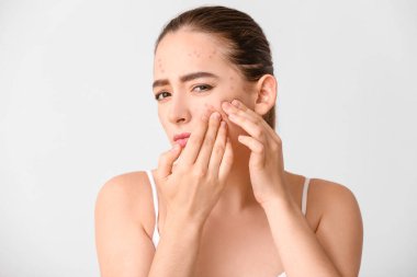 Sivilceli genç bir kadın beyaz arka planda sivilceleri eziyor.