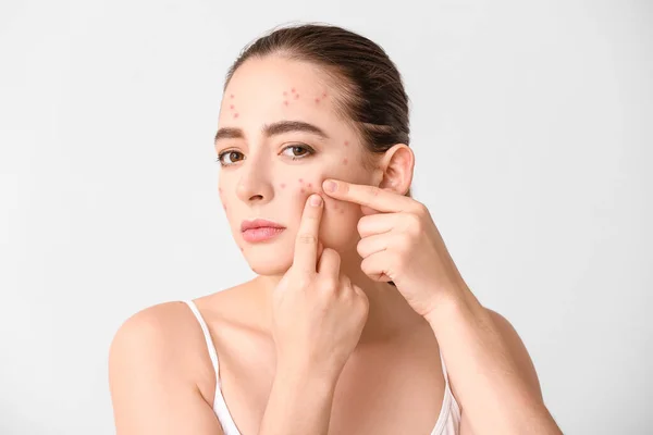 Young Woman Acne Problem Squishing Pimples White Background — Stock Photo, Image