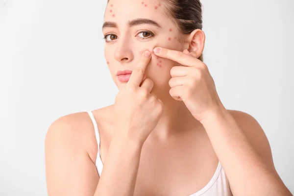 Young Woman Acne Problem Squishing Pimples White Background — Stock Photo, Image