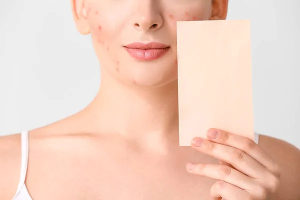 Mujer Joven Con Problemas Acné Tarjeta Blanco Sobre Fondo Claro — Foto de Stock