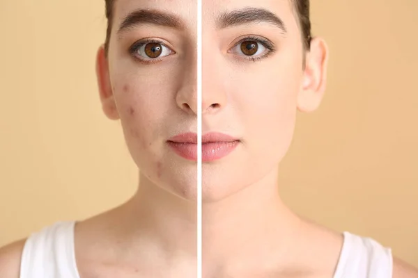 基于肤色背景的痤疮治疗前后的年轻女性 — 图库照片