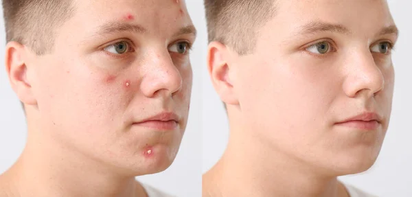 Tiener Jongen Voor Acne Behandeling Lichte Achtergrond — Stockfoto