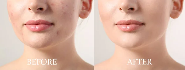 Young Woman Acne Treatment Light Background Closeup — Stock Photo, Image