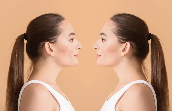 Mujer Joven Antes Después Del Tratamiento Del Acné Fondo Color — Foto de Stock