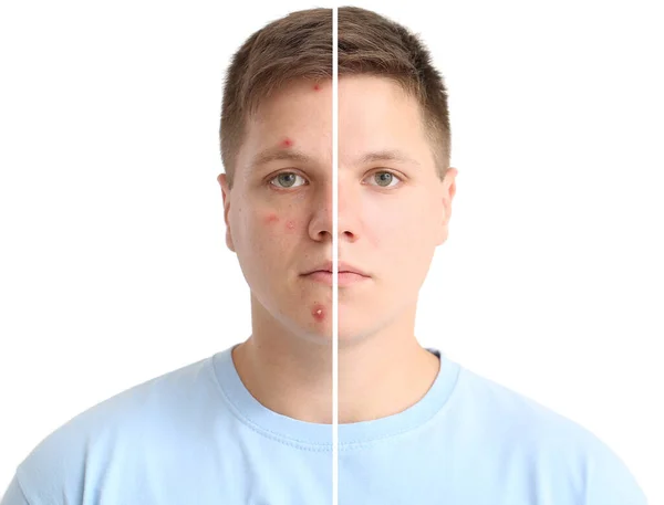 Tiener Jongen Voor Acne Behandeling Lichte Achtergrond — Stockfoto