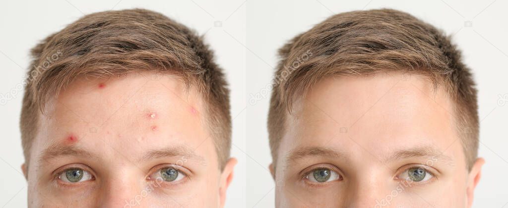 Teenage boy before and after acne treatment on light background, closeup