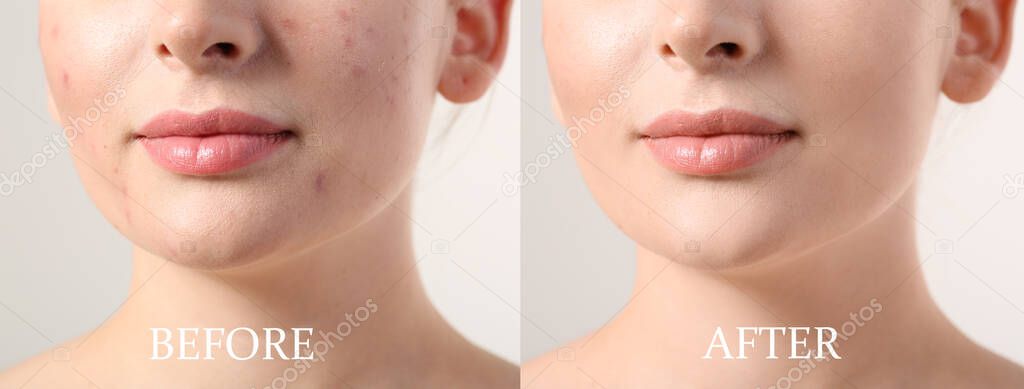 Young woman before and after acne treatment on light background, closeup