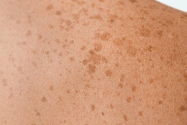 Human skin with freckles, closeup clipart