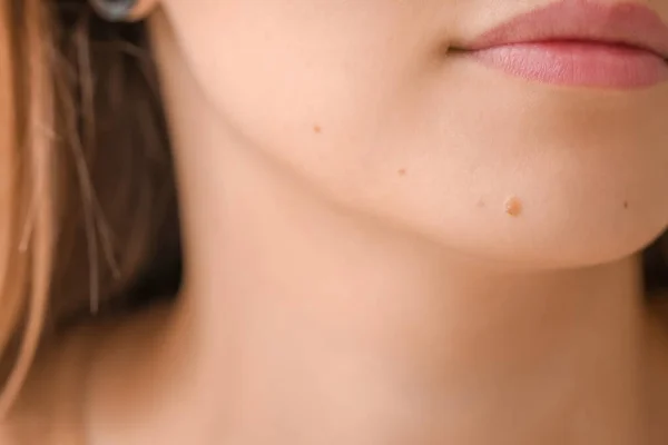 Wanita Dengan Tahi Lalat Kulitnya Closeup — Stok Foto