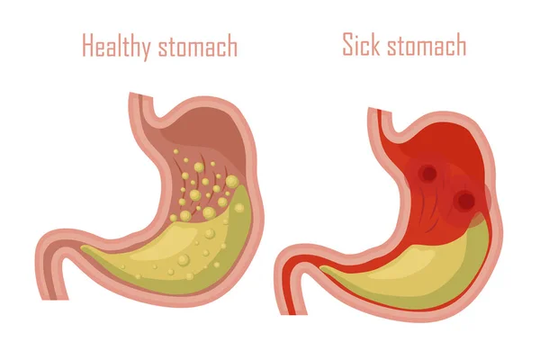 Estómago Humano Sistema Digestivo Estómago Sano Enfermo Vector — Archivo Imágenes Vectoriales
