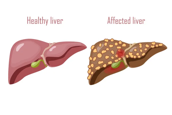 Hígado Humano Sistema Digestivo Hígado Sano Enfermo Cirrosis Vector — Archivo Imágenes Vectoriales