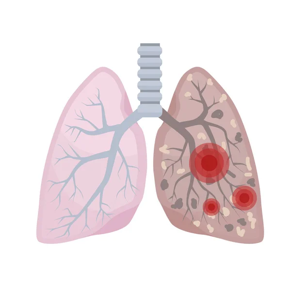 Pulmones Humanos Sistema Respiratorio Pulmón Sano Enfermo Daño Pulmonar Vector — Archivo Imágenes Vectoriales