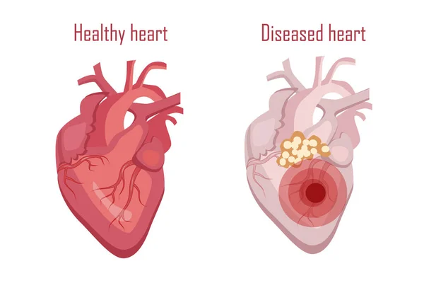 Menselijk Hart Bloedsomloop Ziek Gezond Hart Vector — Stockvector