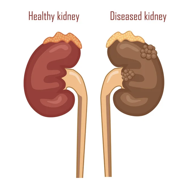 Riñones Humanos Sistema Excretor Riñones Enfermos Sanos Vector — Archivo Imágenes Vectoriales
