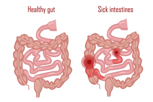 Intestino Humano Intestino Sano Enfermo Sistema Digestivo Vector — Archivo Imágenes Vectoriales