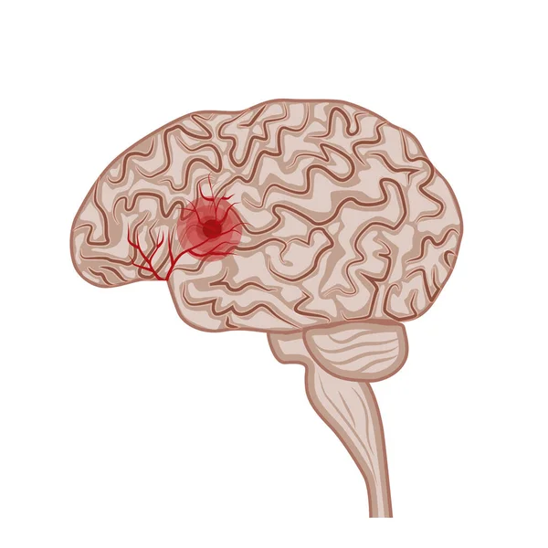 Cerebro Humano Enfermedades Del Cerebro Sistema Nervioso Vector — Archivo Imágenes Vectoriales