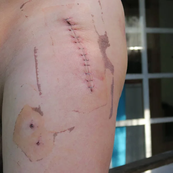 Cicatriz Con Grapas Después Del Uso Una Cadera Artificial Fotos de stock libres de derechos