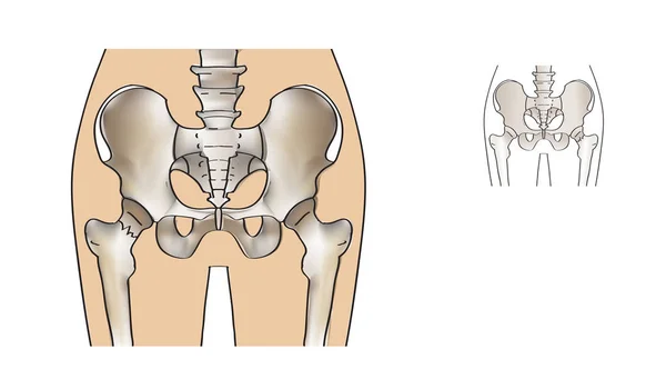 Fractura Cervical Cadera Vector Ilustración Medicina Esqueleto Humano — Archivo Imágenes Vectoriales