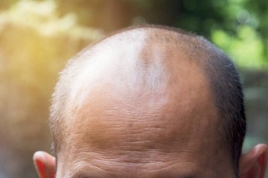 Head of man lose one's hair, glabrous on his head for elderly man. clipart