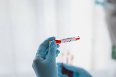 Doktorun elinde eldiven, elinde Coronavirus olan bir tüp kan testi, laboratuvar sonuçlarında pozitif çıktı.