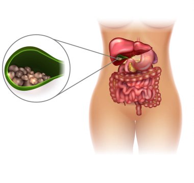 Gallstones in the Gallbladder female silhouette bright detailed illustration clipart