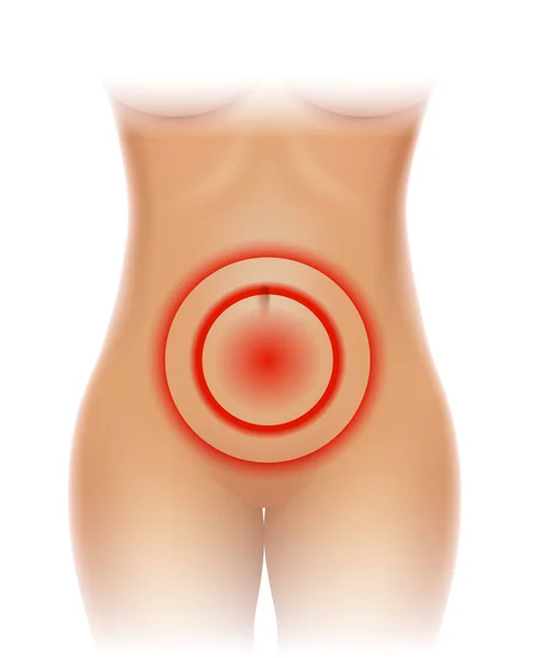 女性の骨盤内の痛み 下腹部痛 — ストックベクタ