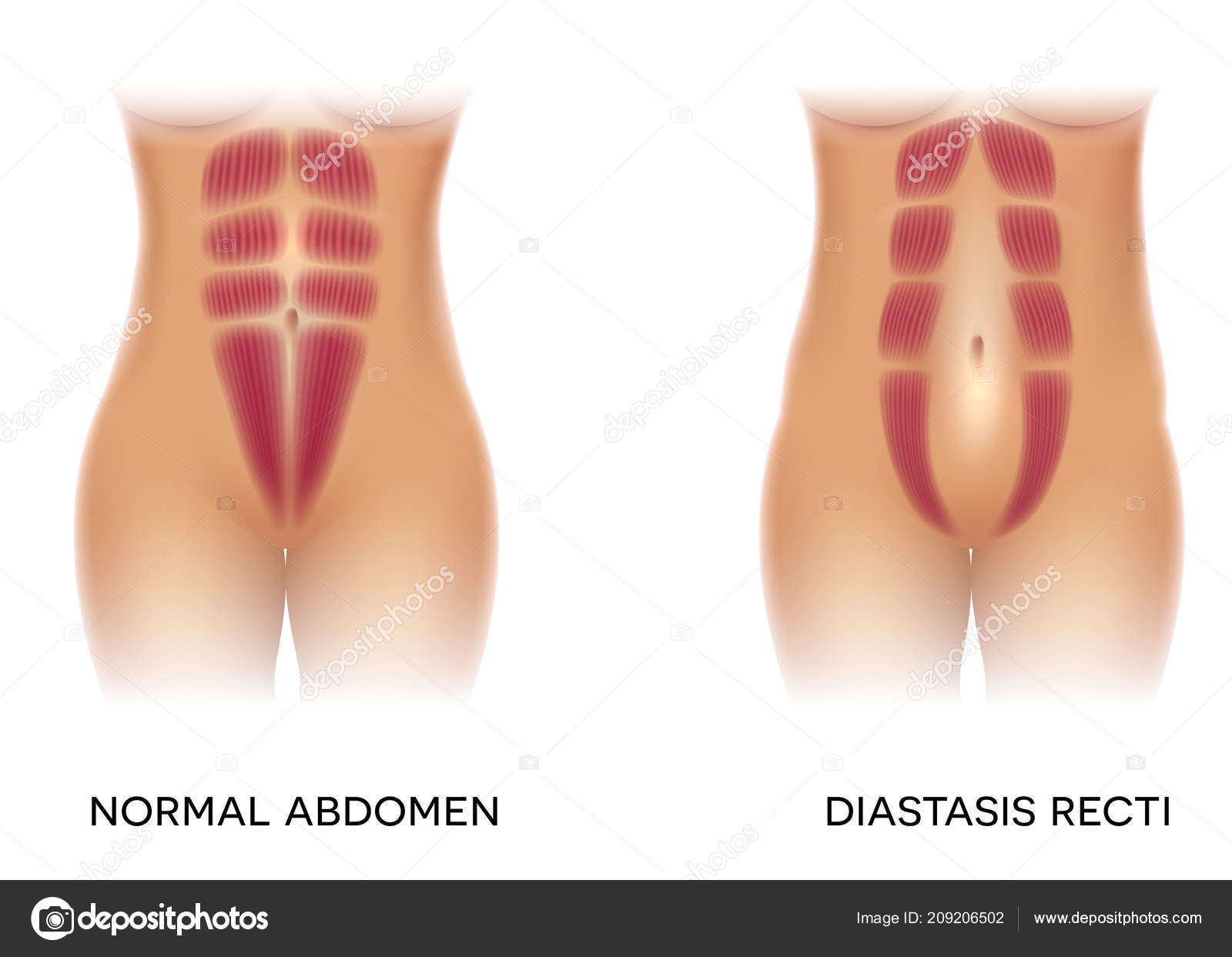 Rectus Abdominis Abdominal Belt For Diastasis Recti Belly Binder