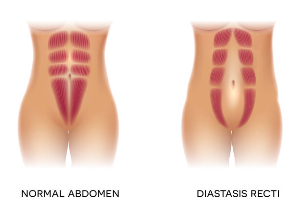 Diastasis recti also known as abdominal separation, it is common among pregnant women. There is a gap between the rectus abdominis muscles.