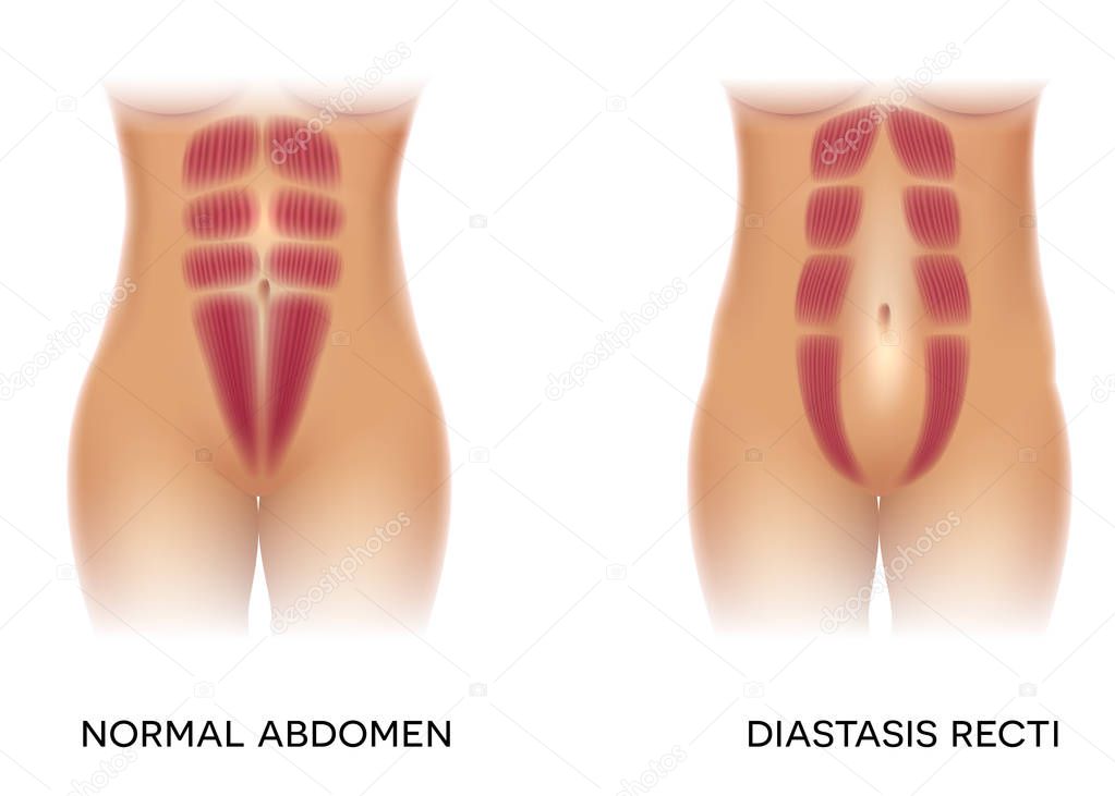Diastasis recti also known as abdominal separation, it is common among pregnant women. There is a gap between the rectus abdominis muscles.