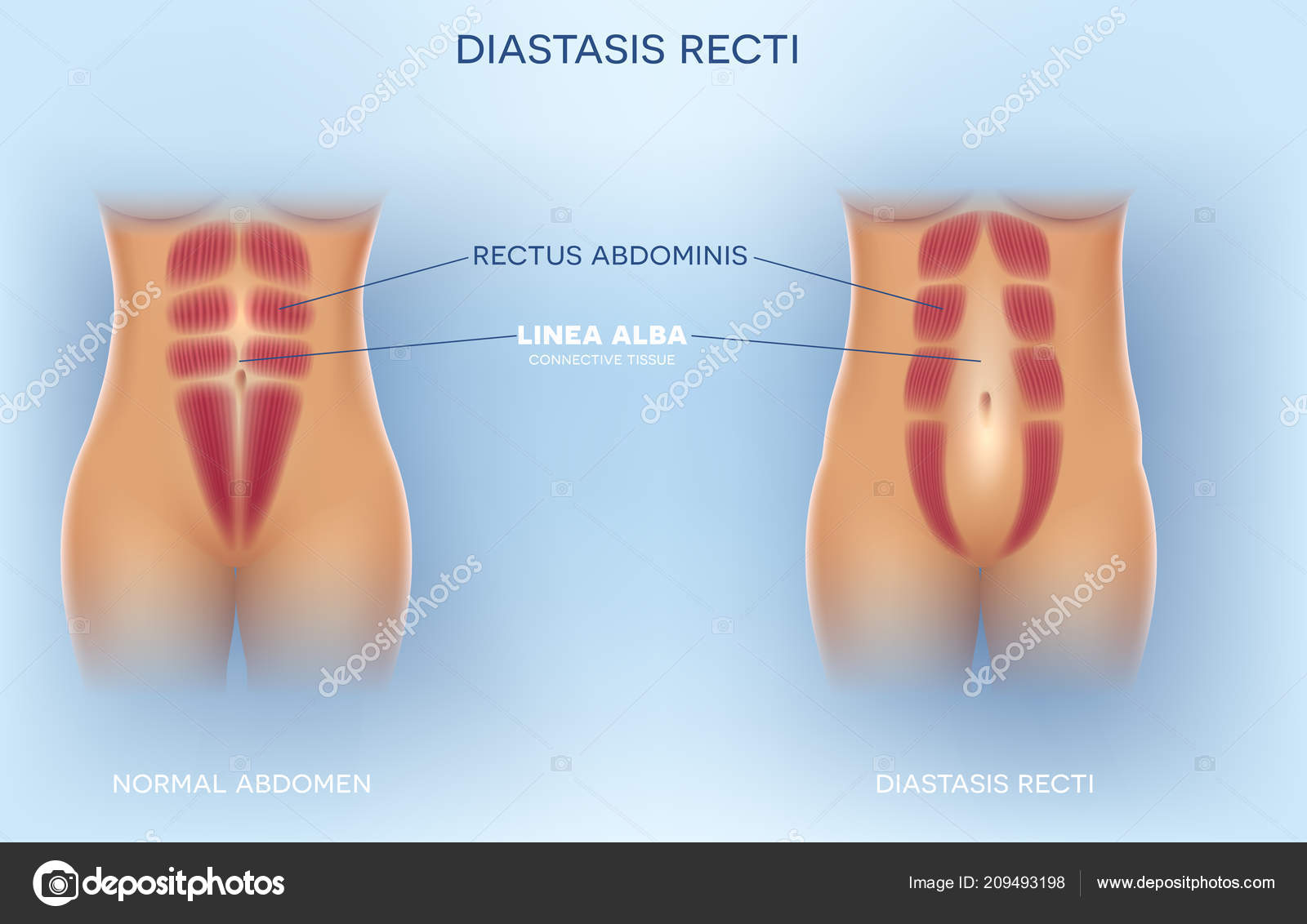 separacion de los musculos abdominales