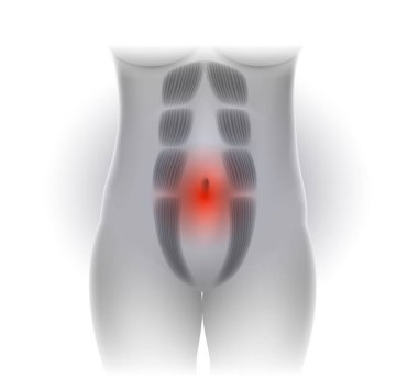 Tabii Recti olarak da bilinen tabii Rektus Abdominus veya karın ayrılık, hamile kadınlar ve sonrası Doğum arasında yaygındır. Rektus karın kasları arasında bir boşluk olduğunu.
